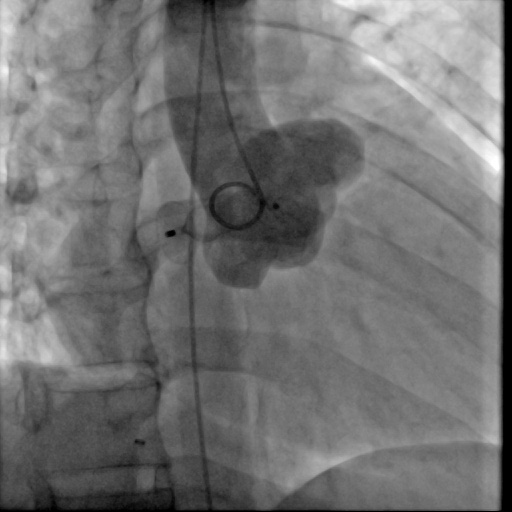 张嘉淋术后.jpg 张嘉淋术后.jpg