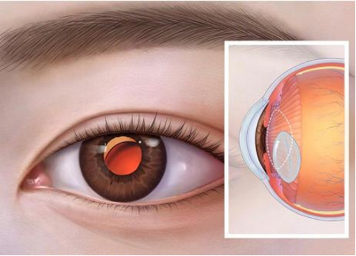 微创手术解决人工晶体移位，市三医院眼科巧妙助力患者恢复视力