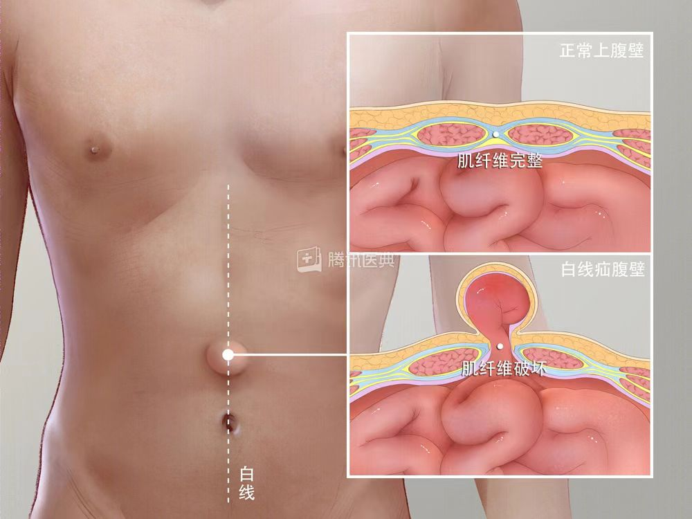 脂肪瘤？白线疝！市三医院运用微创新技术轻松搞定