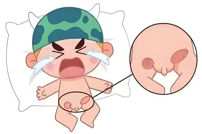 宝宝腹股沟有包块？3分钟看懂疝气要不要手术！