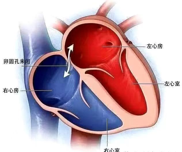 反复偏头痛？可能和心脏有关  右心声学造影帮你揪出元凶